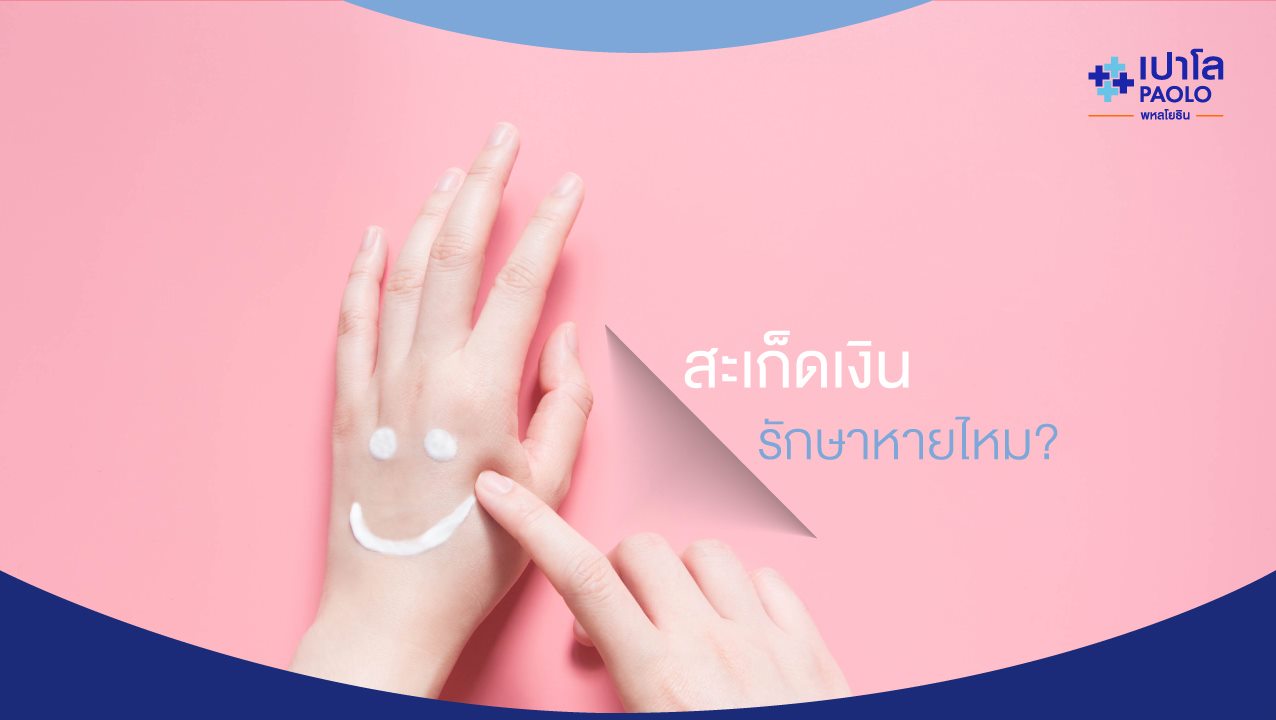 โรคสะเก็ดเงินรักษาหายไหม? มีวิธีรักษาทางไหนได้บ้าง?