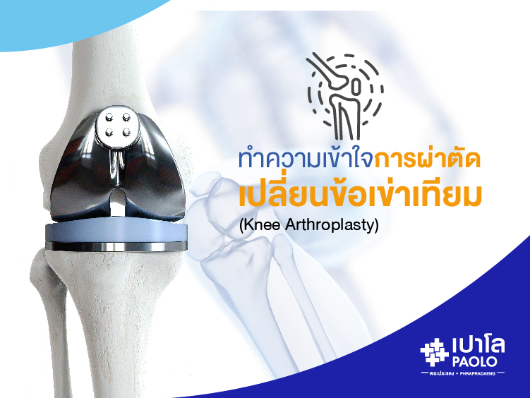 การผ่าตัดเปลี่ยนข้อเข่าเทียม (Knee Arthroplasty)