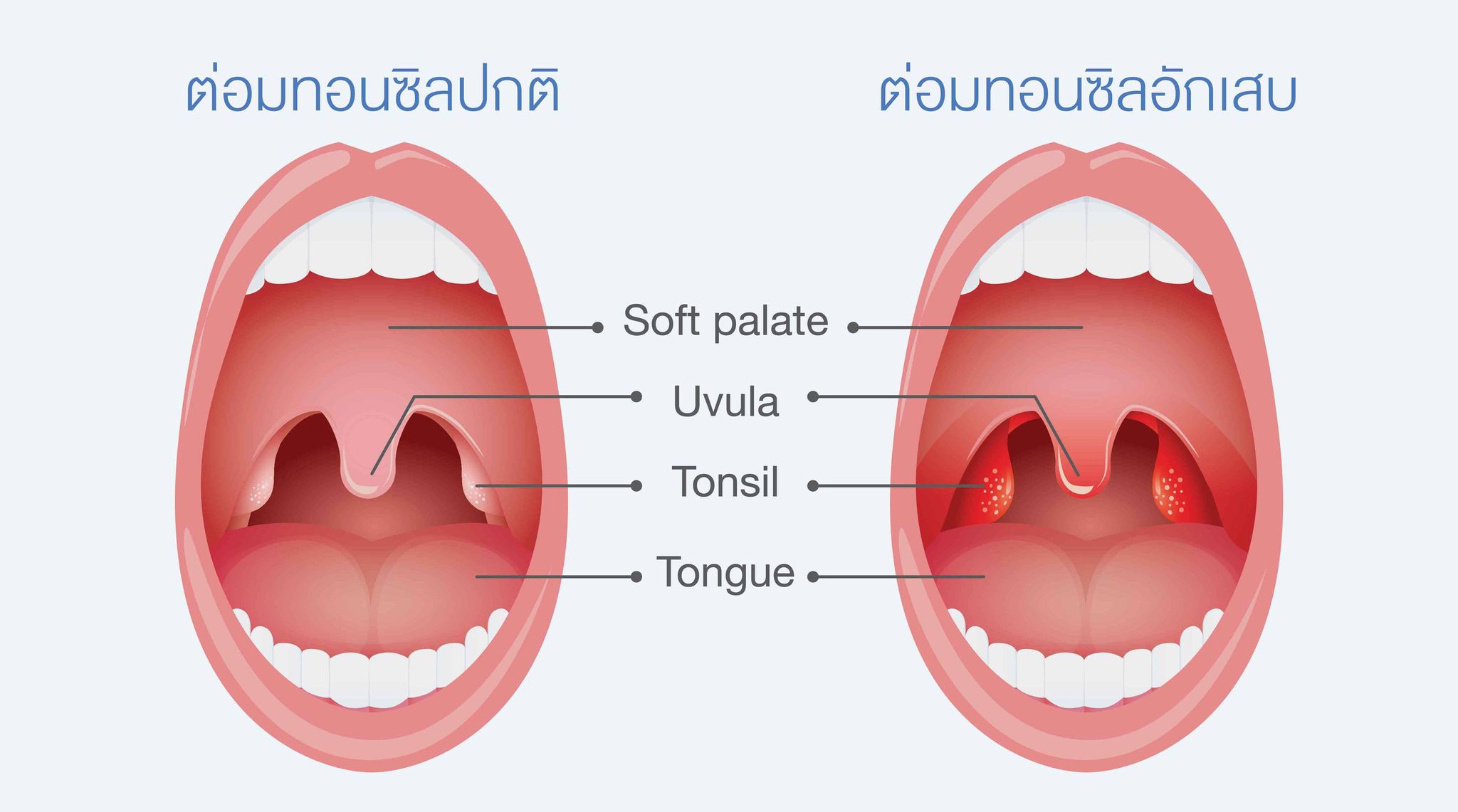 ผ่าตัดต่อมทอนซิลออกเมื่อไรดี?