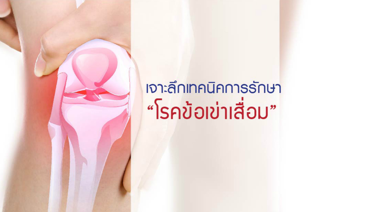 เจาะลึกเทคนิคการรักษา “โรคข้อเข่าเสื่อม”