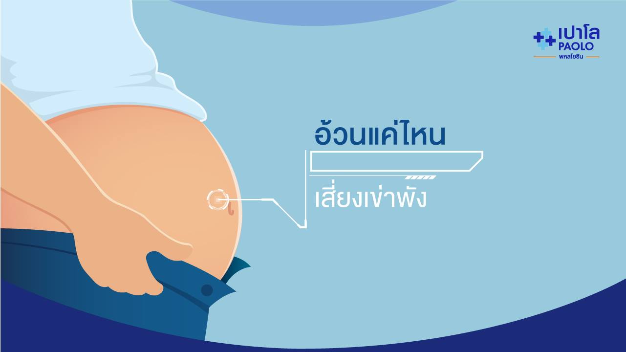 อ้วนแค่ไหน…เสี่ยงเข่าพัง