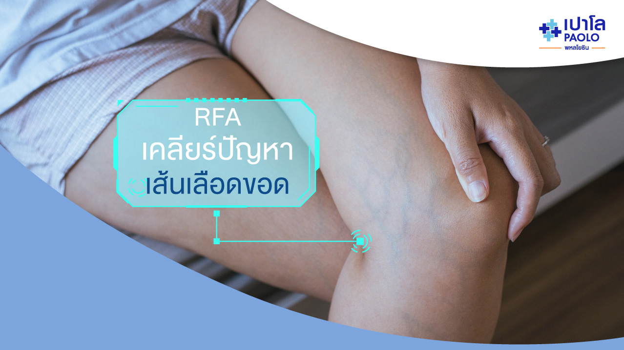 “RFA” เทคโนโลยีใหม่...ช่วยจัดการปัญหาเส้นเลือดขอด