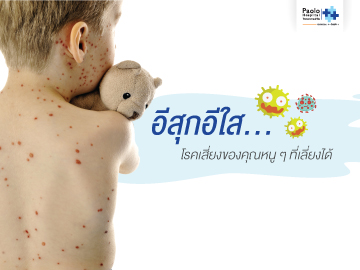 อีสุกอีใส… โรคเสี่ยงของคุณหนู ๆ ที่เลี่ยงได้