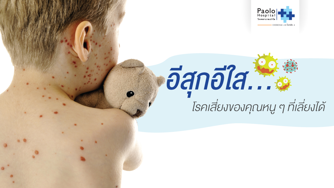 อีสุกอีใส… โรคเสี่ยงของคุณหนู ๆ ที่เลี่ยงได้