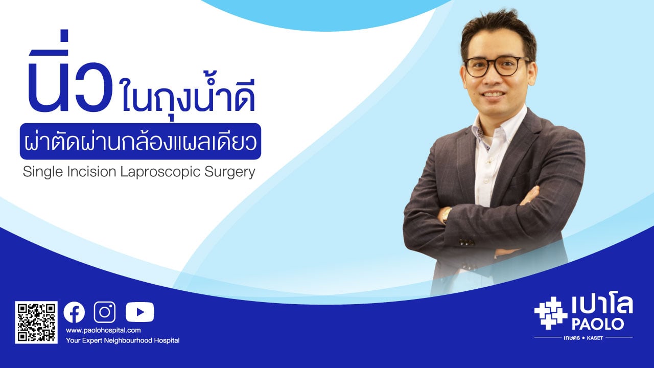 การผ่าตัดนิ่วในถุงน้ำดีผ่านกล้องแผลเดียว (Single Port Laparoscopic Cholecystectomy)