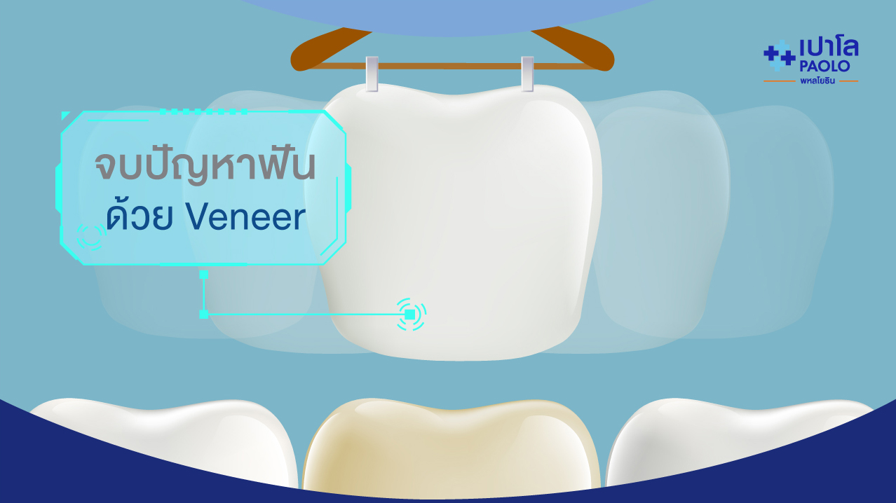 เติมความสดใสให้รอยยิ้ม ด้วยการเคลือบฟันเทียม (VENEER) 