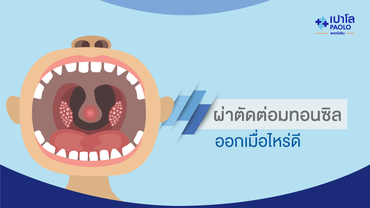 ผ่าตัดต่อมทอนซิลออกเมื่อไรดี?