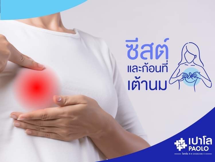 ซีสต์และก้อนที่เต้านม