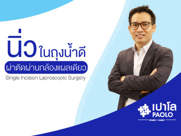 การผ่าตัดนิ่วในถุงน้ำดีผ่านกล้องแผลเดียว (Single Port Laparoscopic Cholecystectomy)