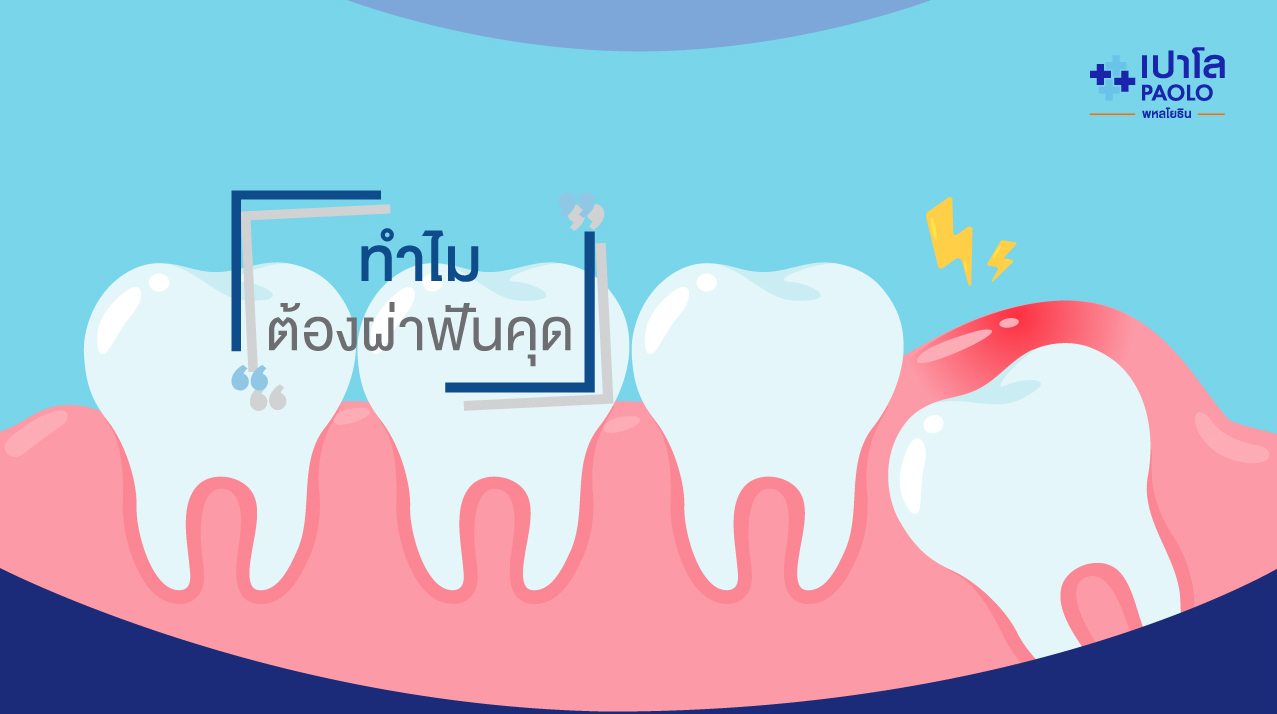 ทำไมเราต้องผ่าฟันคุด?