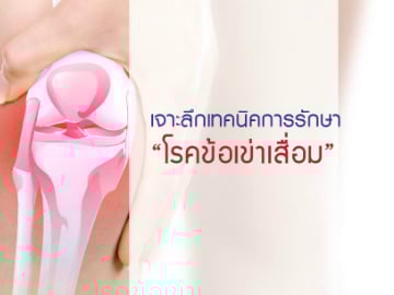 เจาะลึกเทคนิคการรักษา “โรคข้อเข่าเสื่อม”