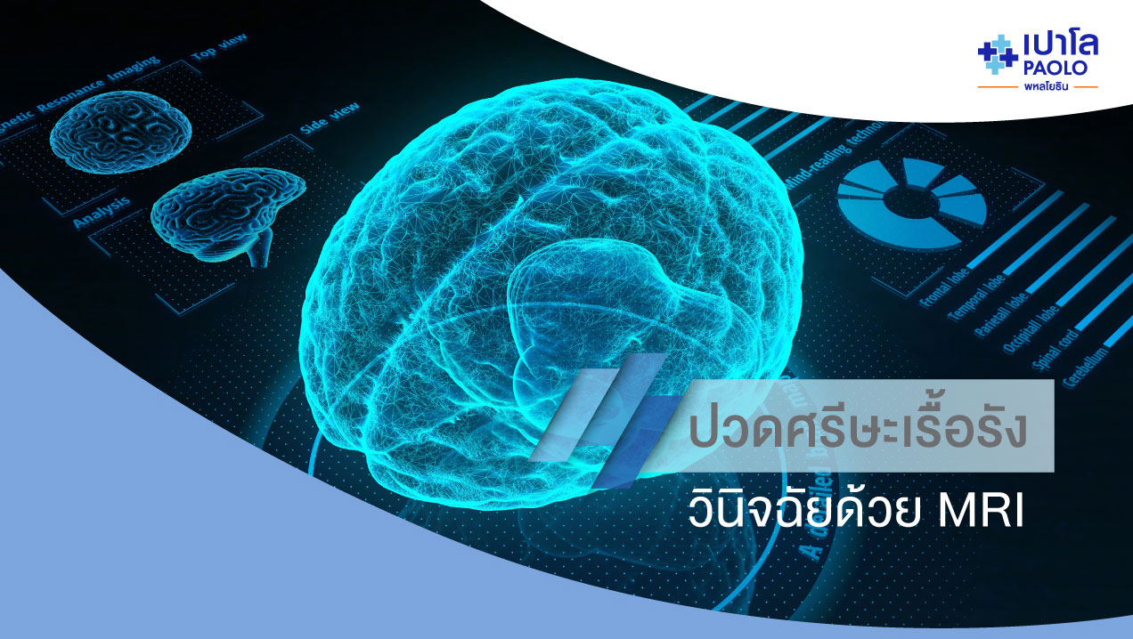 ปวดศีรษะเรื้อรัง แขนขา ใบหน้าอ่อนแรง วินิจฉัยด้วย MRI | โรงพยาบาลเปาโล - Paolo Hospital ปวดศีรษะเรื้อรัง แขนขา ใบหน้าอ่อนแรง วินิจฉัยด้วย Mri | โรงพยาบาลเปาโล - Paolo Hospital