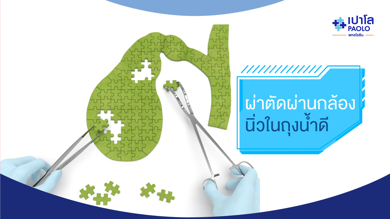 ผ่าตัดผ่านกล้อง“นิ่วในถุงน้ำดี” ทางเลือกใหม่ที่สบายตัวกว่า