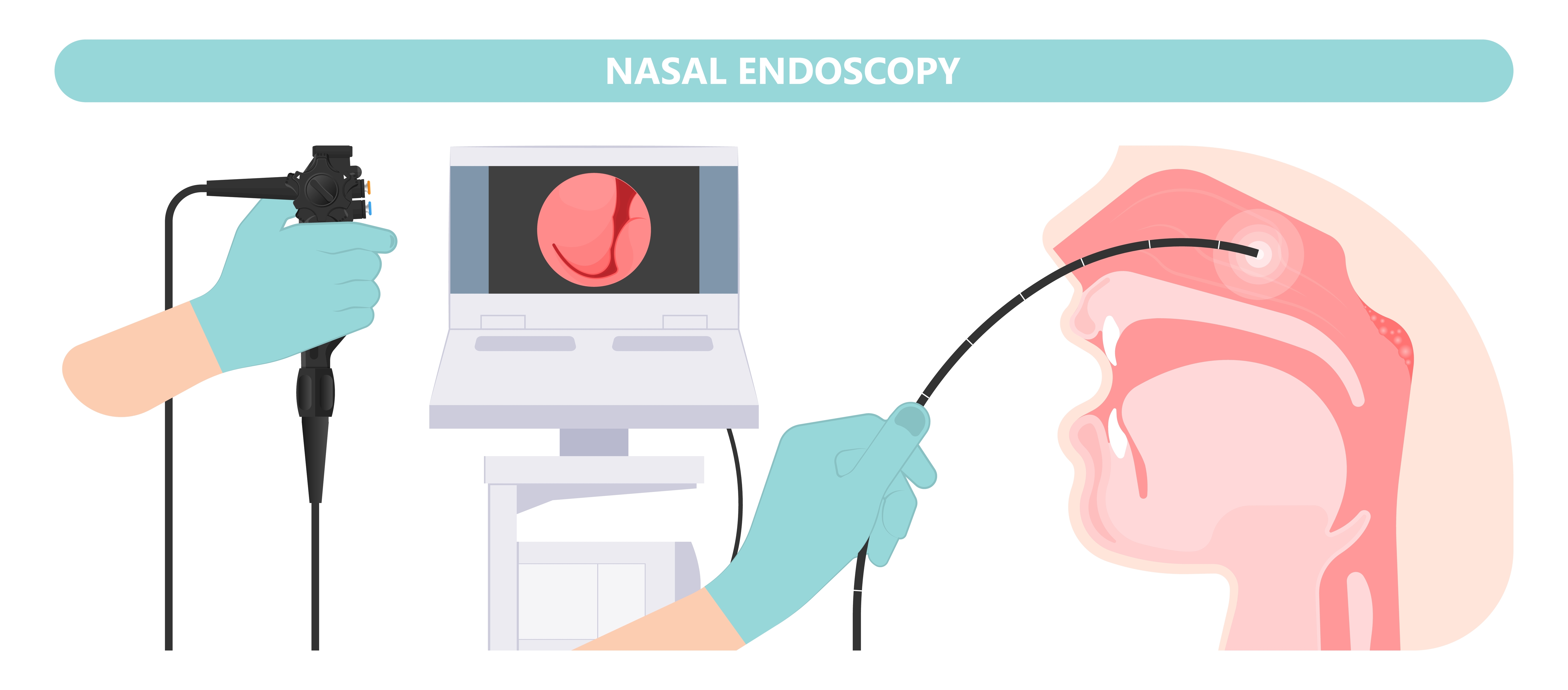 nasal endoscopy ผนังกั้นช่องจมูกคด