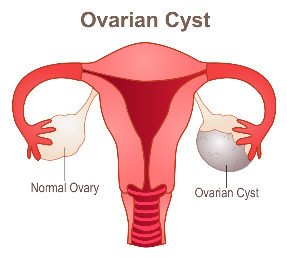 ovarian cysts