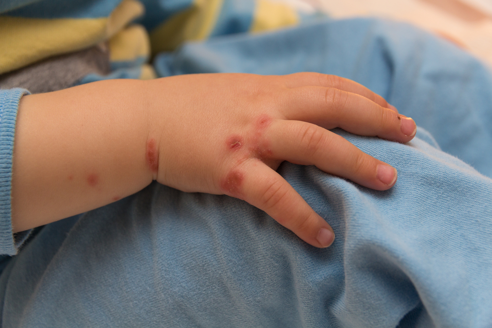 โรคมือเท้าปากโรคระบาดในเด็กที่ไม่ควรมองข้าม